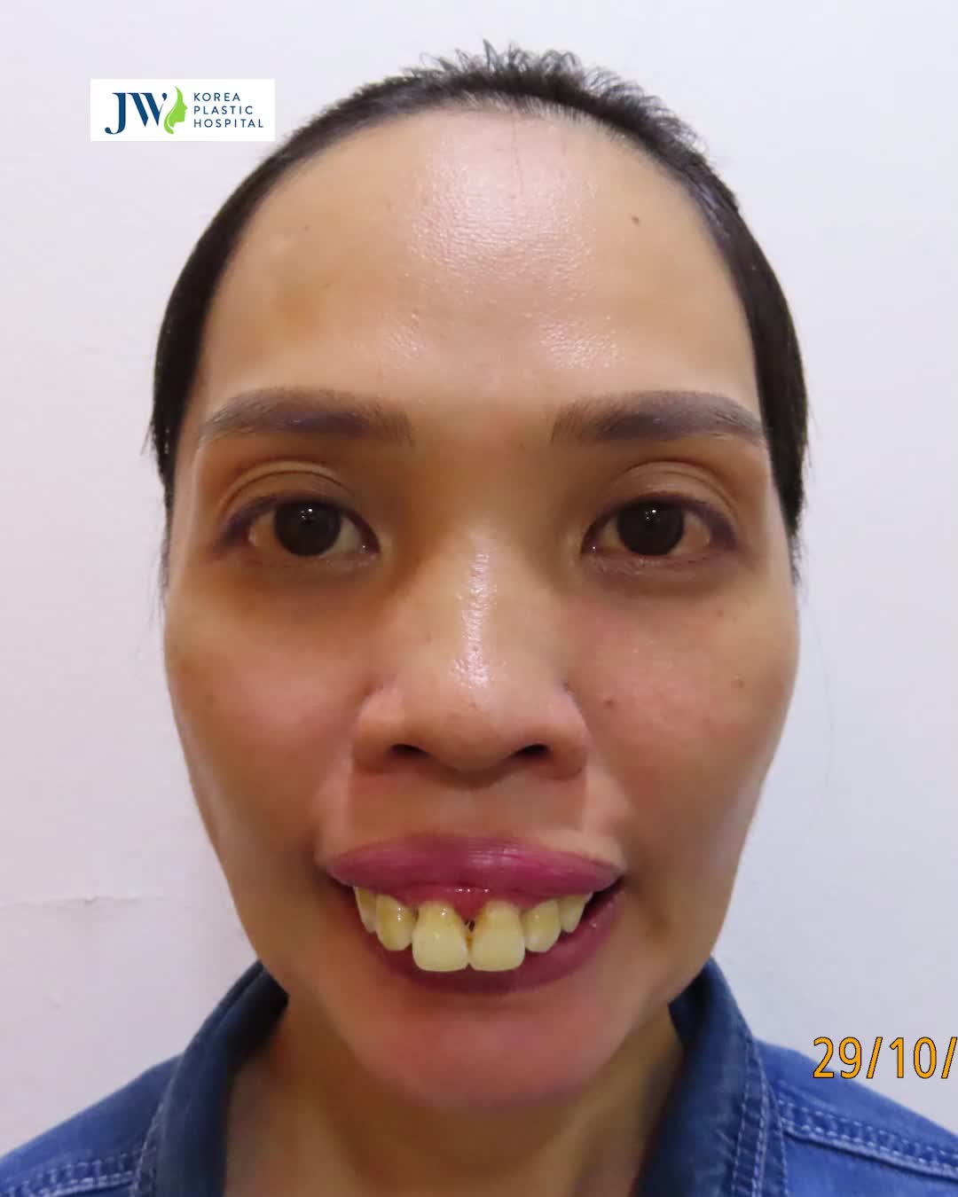 THỰC HƯ chuyện cô gái đến JW Phẫu thuật hàm hô tạm biệt quá khứ 30 NĂM bị người đời chọc NẠO DỪA